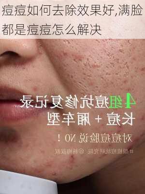 痘痘如何去除效果好,满脸都是痘痘怎么解决